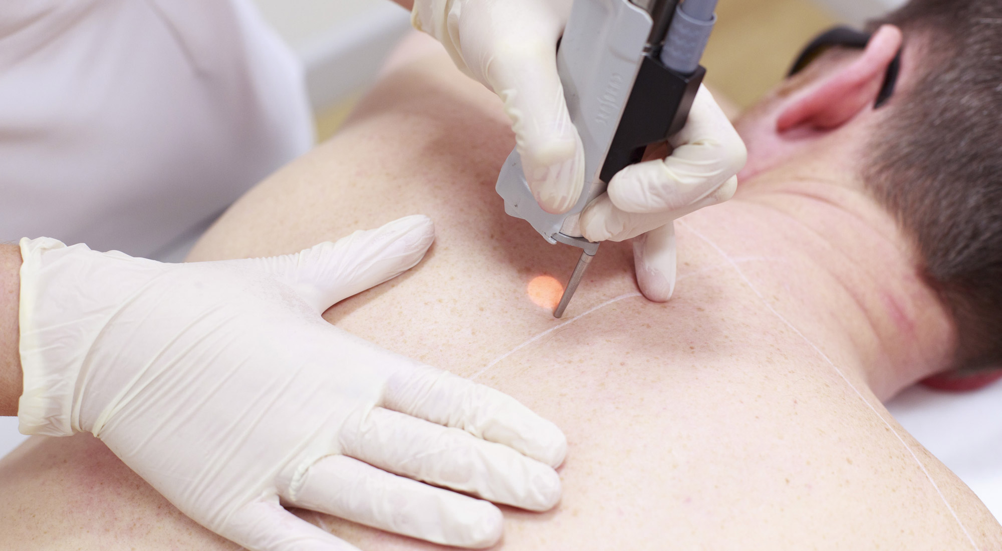 ازالة الشعر للرجال بالليزر