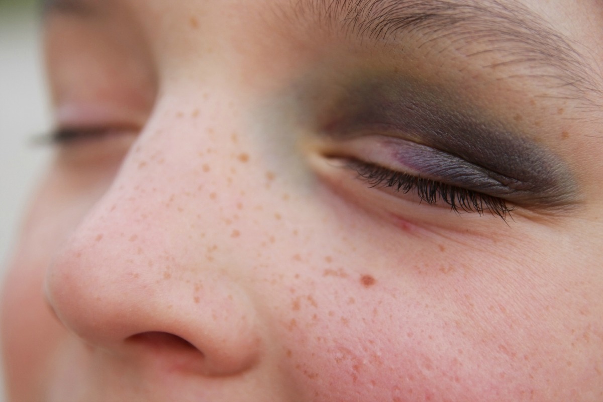 اشكال الكدمات