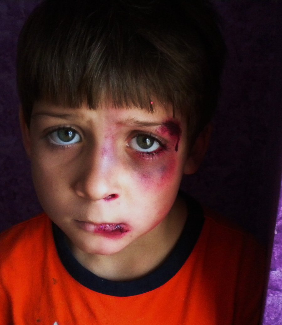 اعراض الكدمات