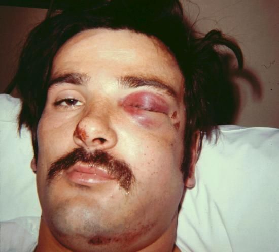 خثار الجيب الكهفي