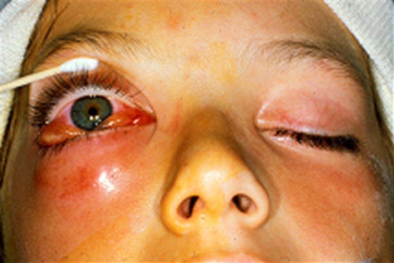 اعراض خثار الجيب الكهفي