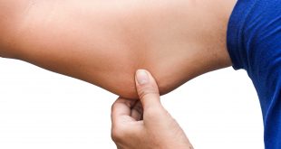 ترهل الذراعين والتخلص منه