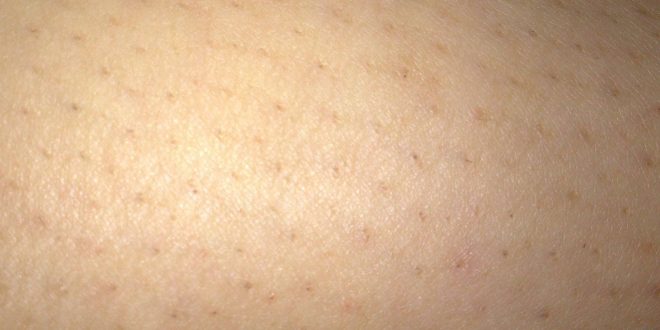 مسامات الساق