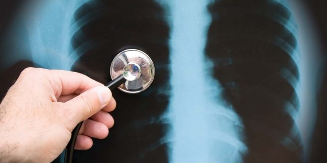 الالتهاب الرئوي