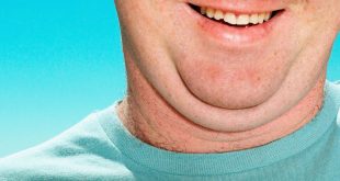 الذقن المزدوج