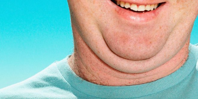 الذقن المزدوج