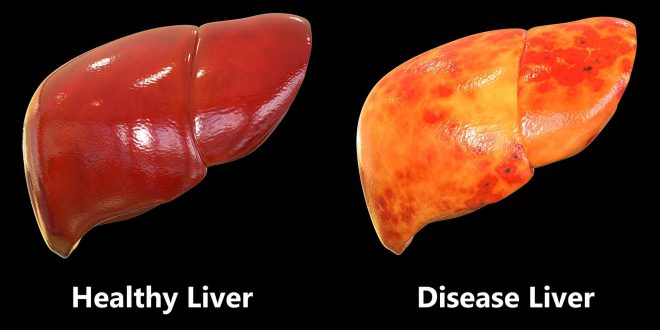 الكبد الدهني