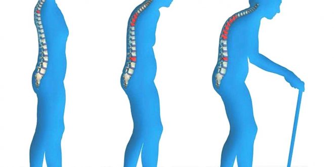 الوقاية من هشاشة العظام