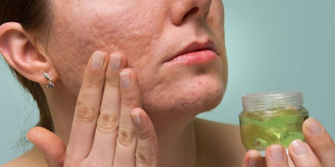 التخلص من الندوب