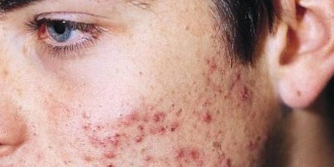 الحبوب تحت الجلد