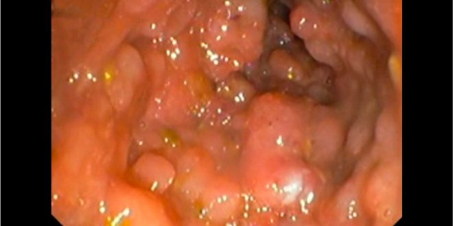 القولون التقرحي