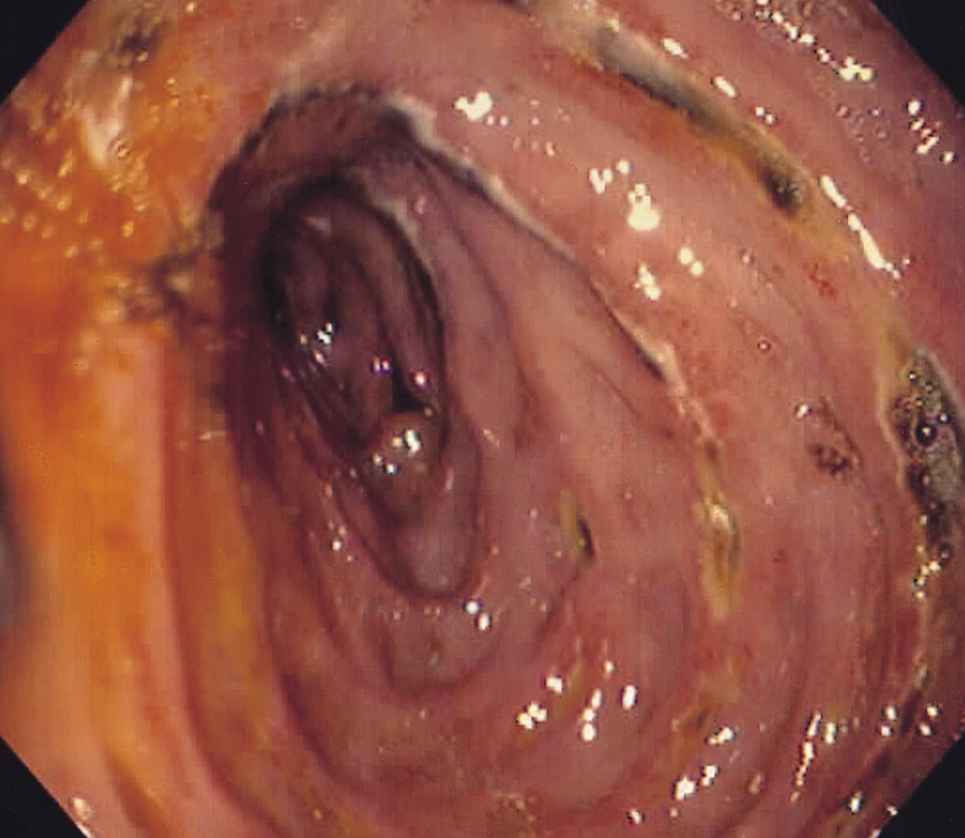 متلازمة زولينجر إليسون ماهي