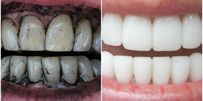 وصفة لتبييض الأسنان