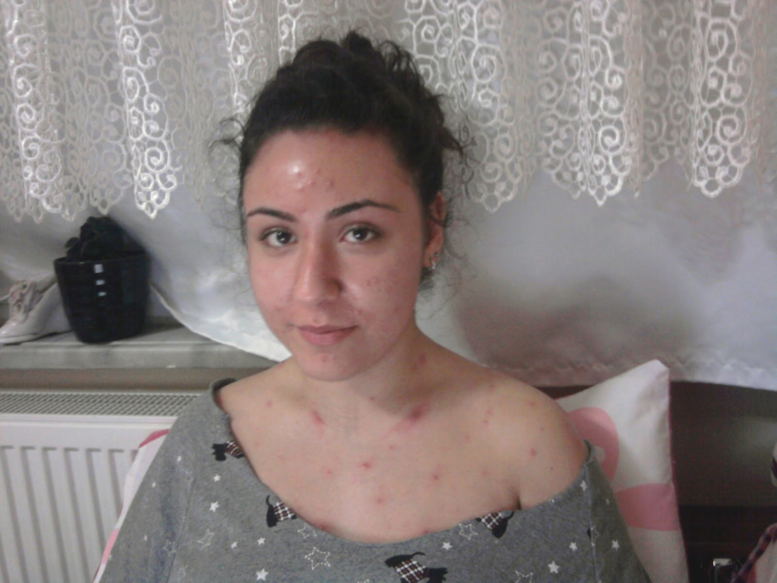 اعراض الجديري