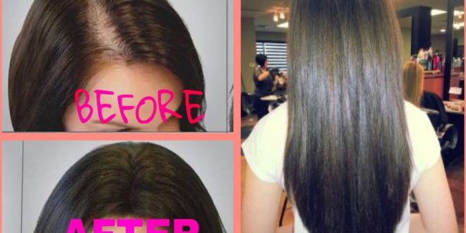 علاج تساقط الشعر عند النساء