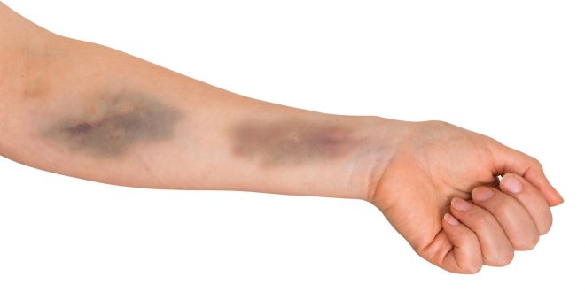 اسباب الكدمات