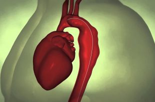 تمدد الأوعية الدموية
