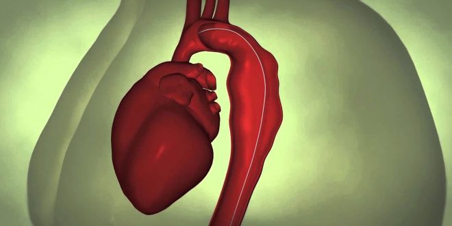 تمدد الأوعية الدموية