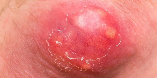 اسباب الدمل