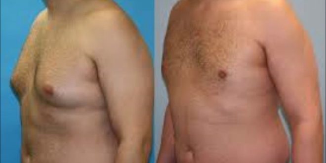 تضخم الثدي عند الرجال